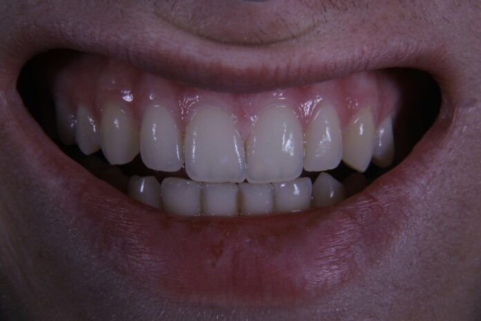 Photo by Ozkan Guner a close up of a person's mouth with a missing tooth